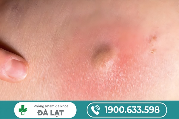 Nổi Hạch Ở Bao Quy Đầu Nam Giới 