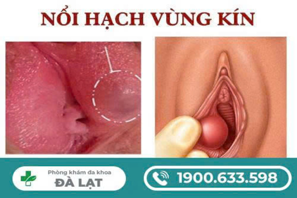 Nổi Hạch Ở Vùng Kín Nữ Giới 