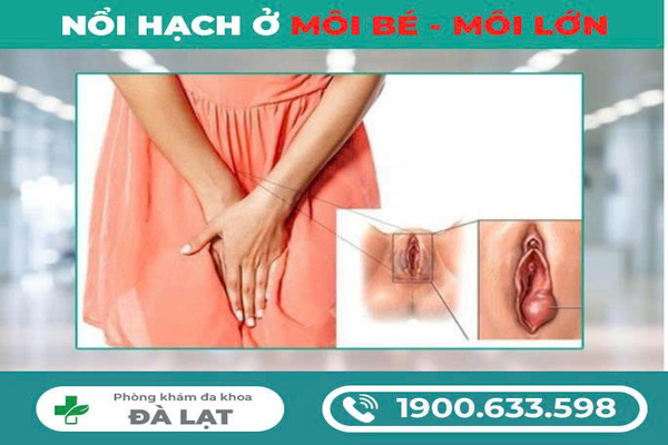 Nổi Hạch Ở Môi Lớn, Môi Bé Nữ Giới 