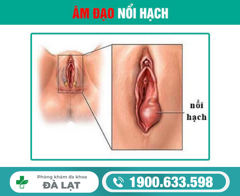 Nổi Hạch Ở Âm Đạo Nữ Giới 