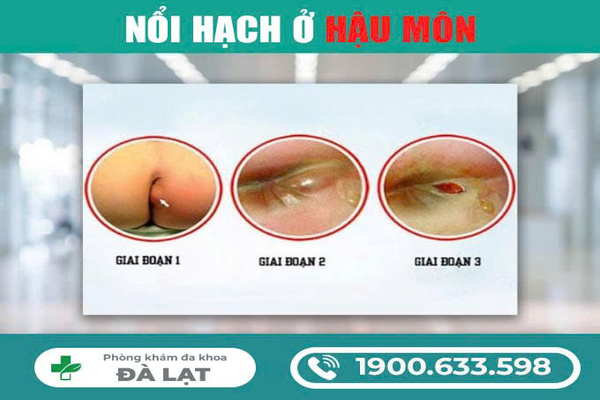 Nổi Hạch Ở Hậu Môn Cảnh Báo Bệnh Gì? 