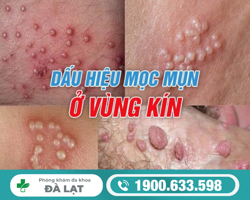 Hai Mép Vùng Kín Nổi Mụn 