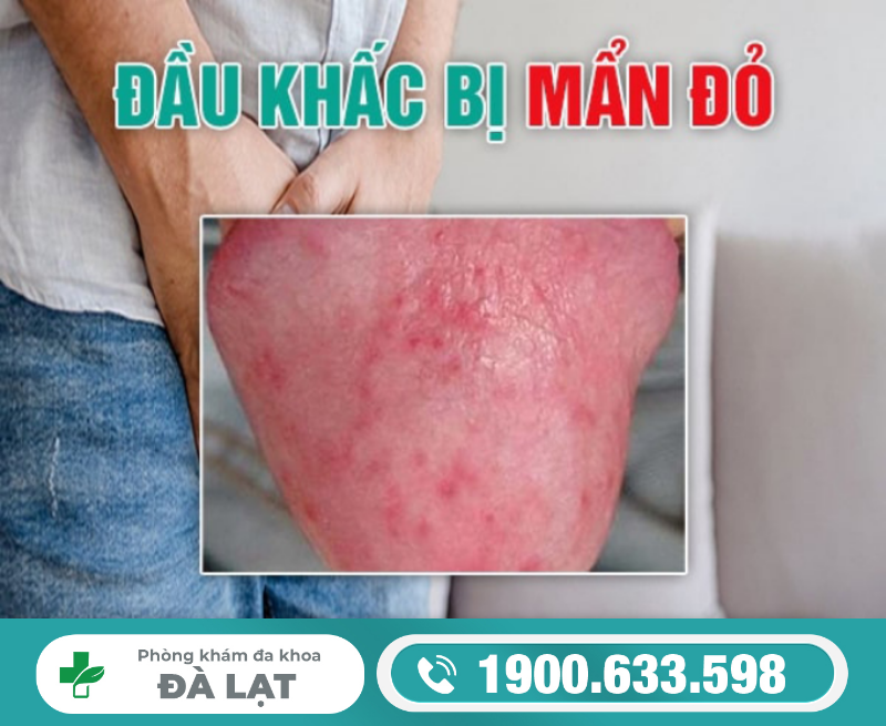Nổi Mẩn Đỏ Ở Đầu Khấc Nam Giới