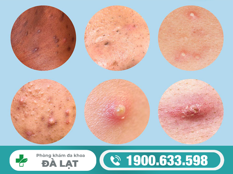 Các Loại Mụn Mọc Ở Vùng Kín Thường Gặp 