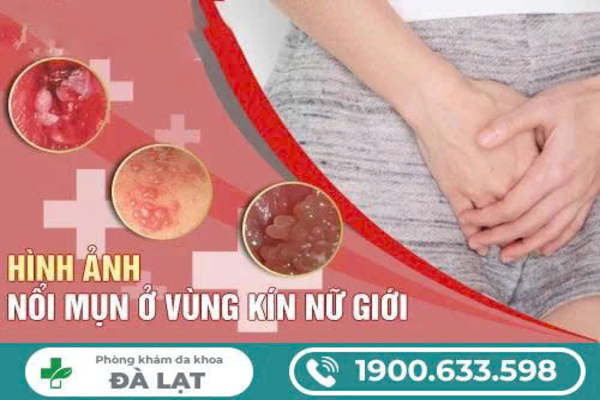 Hình Ảnh Nổi Mụn Ở Vùng Kín Nữ Giới 