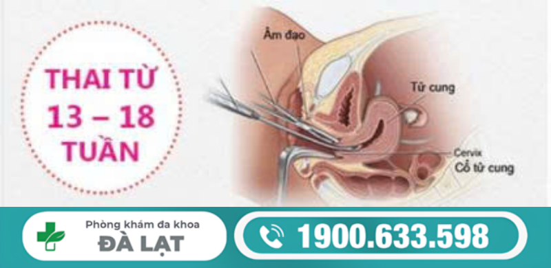 CÓ NÊN HÚT THAI TRÊN 12 TUẦN ĐẾN 18 TUẦN KHÔNG?