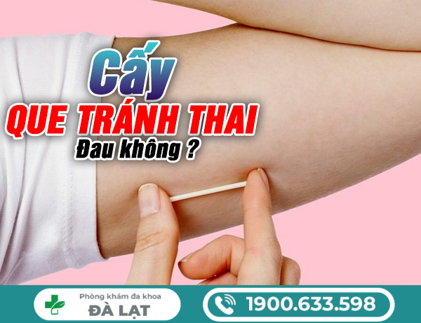 NỮ GIỚI CẤY QUE TRÁNH THAI CÓ ĐAU KHÔNG?