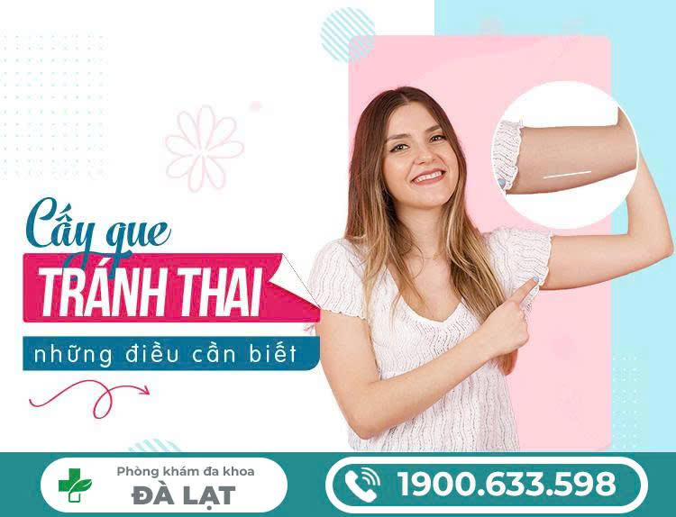 CẤY QUE TRÁNH THAI: PHƯƠNG PHÁP HIỆN ĐẠI VÀ AN TOÀN