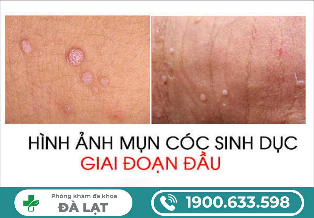 NỔI MỤN CÓC Ở VÙNG KÍN NỮ GIỚI