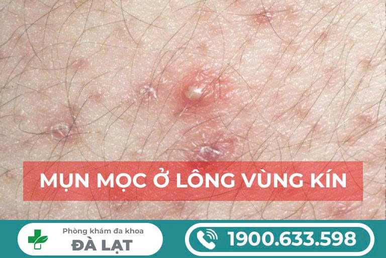 Mọc Mụn Ở Lông Vùng Kín Nữ Giới 