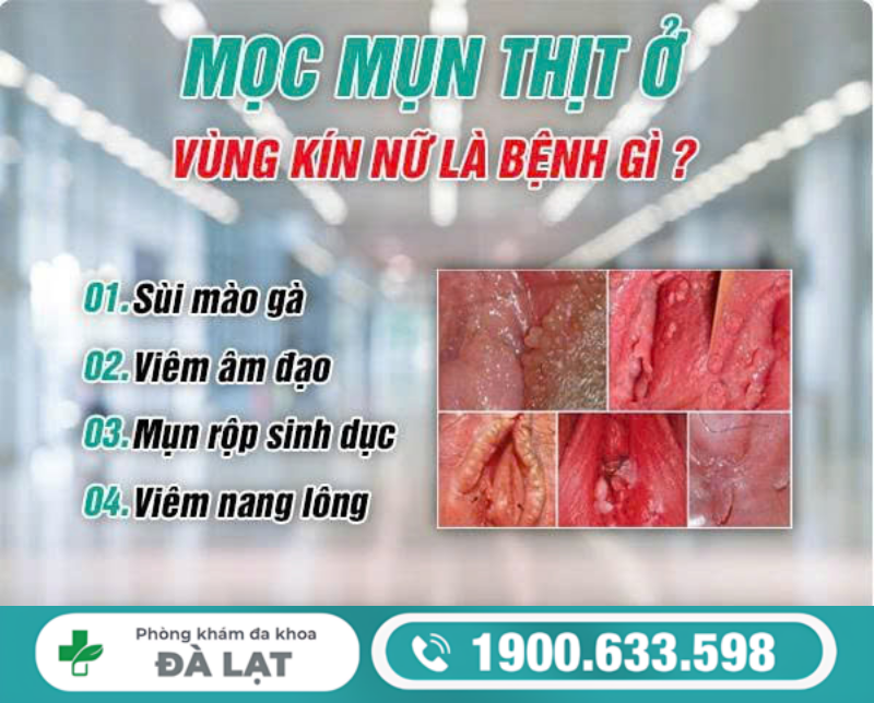 MỌC MỤN THỊT Ở VÙNG KÍN NỮ LÀ BỆNH GÌ?