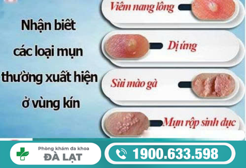 NỔI MỤN LITI Ở VÙNG KÍN NỮ LÀ BỆNH GÌ?