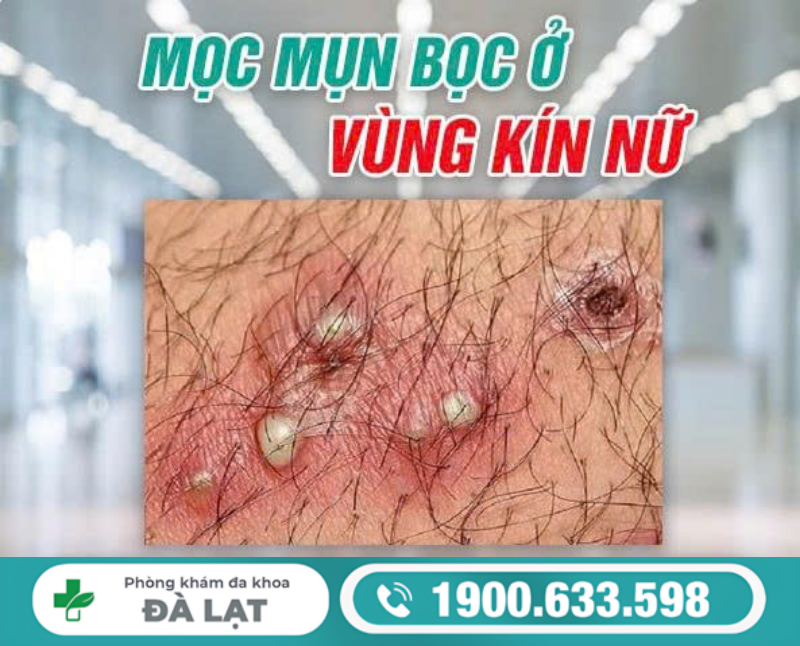 MỌC MỤN BỌC Ở VÙNG KÍN NỮ LÀ BỆNH GÌ?
