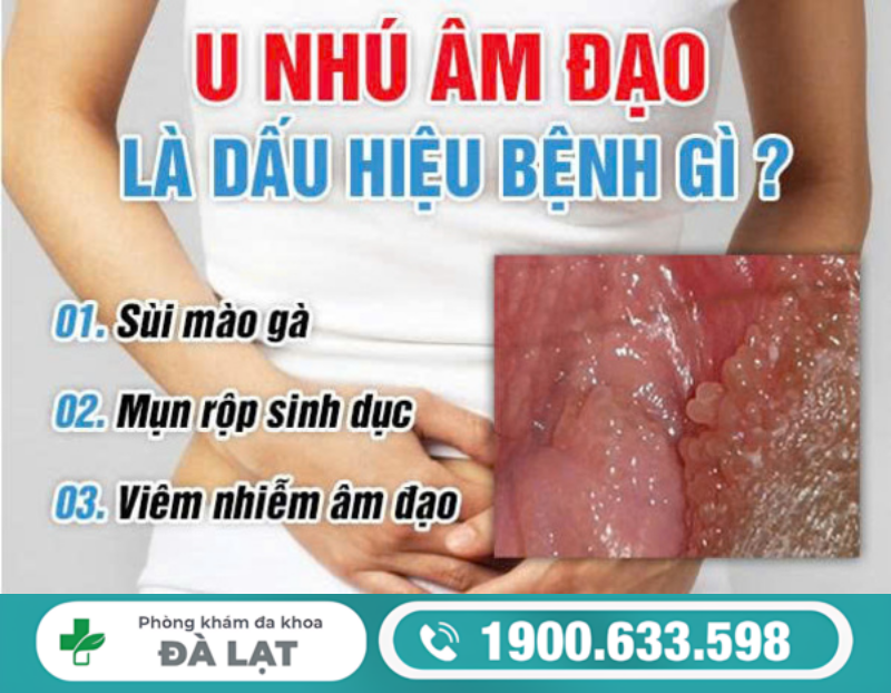U NHÚ SINH DỤC NỮ CẢNH BÁO BỆNH GÌ?