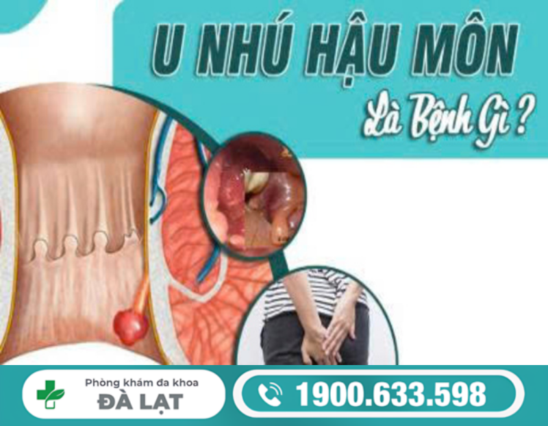 TÌM HIỂU VỀ U NHÚ HẬU MÔN