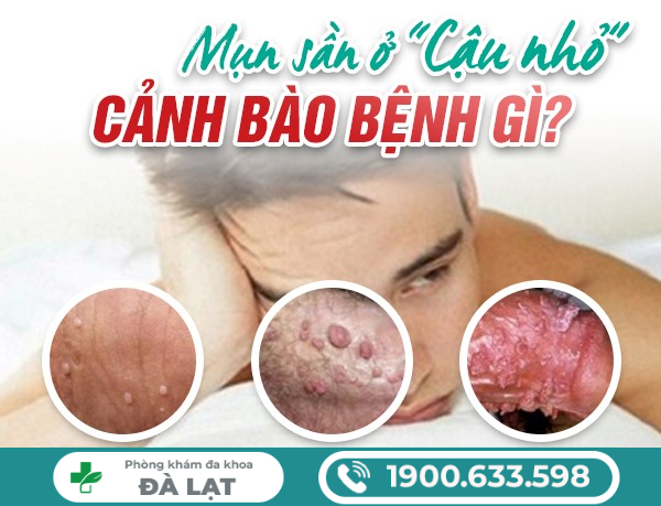 BAO QUY ĐẦU SẦN SÙI CẢNH BÁO BỆNH NAM KHOA