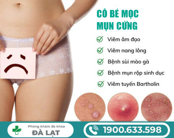 Cô Bé Mọc Mụn Cứng Là Bệnh Gì? 