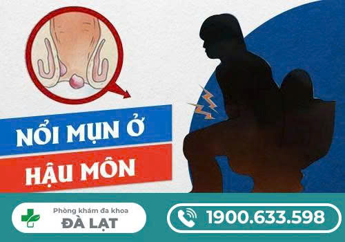 Tìm Hiểu Về Các Loại Mụn Ở Hâu Môn và Cách Điều Trị 