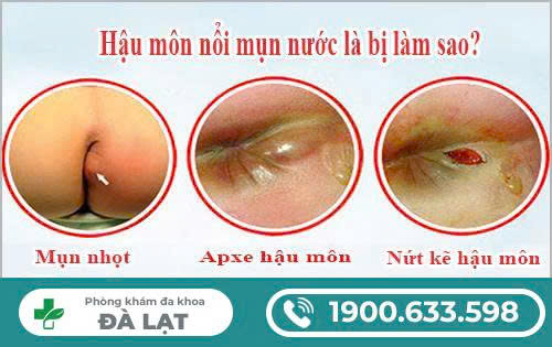 Mụn Nước ở Hậu Môn
