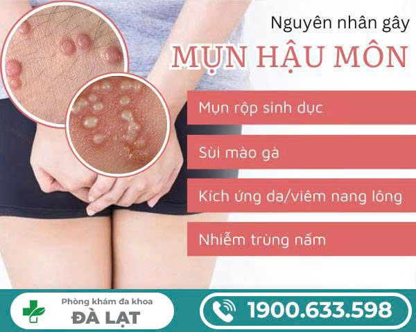 Mọc Mụn Cơm Ở Hậu Môn 