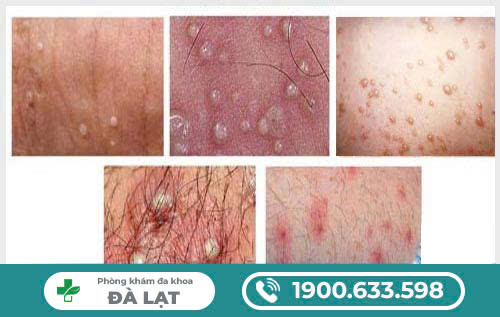 Hậu Môn Bị Ngứa Và Nổi Mụn 