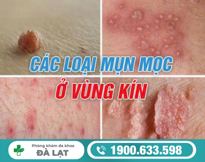 NAM VÀ NỮ BỊ MỌC MỤN MỦ Ở VÙNG KÍN 
