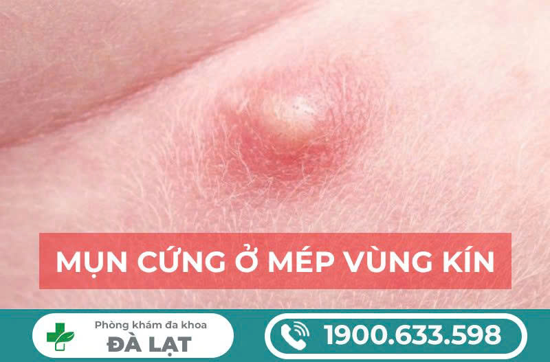 NAM VÀ NỮ BỊ NỔI MỤN CỨNG Ở VÙNG KÍN 