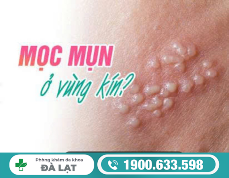 CẬU NHỎ NỔI MỤN CÓ ẢNH HƯỞNG GÌ KHÔNG?