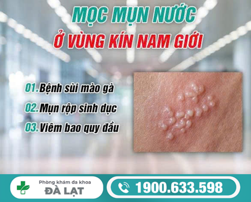 MỌC MỤN NƯỚC Ở CẬU NHỎ CẢNH BÁO BỆNH GÌ?