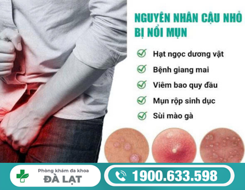 NGUYÊN NHÂN PHỔ BIẾN KHIẾN CẬU NHỎ NỔI MỤN