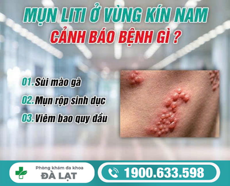 CẬU NHỎ MỌC MỤN LITI LÀ BỆNH GÌ?