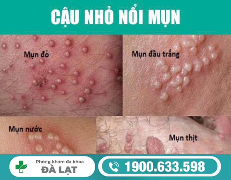 MỌC MỤN Ở CẬU NHỎ LÀ BỆNH GÌ?