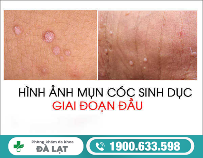 TÌM HIỂU MỤN CÓC SINH DỤC GIAI ĐOẠN ĐẦU