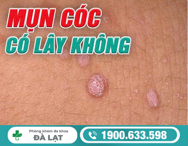 GIẢI ĐÁP: MỤN CÓC SINH DỤC CÓ LÂY KHÔNG?