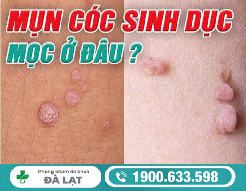 TÌM HIỂU MỤN CÓC SINH DỤC MỌC Ở ĐÂU