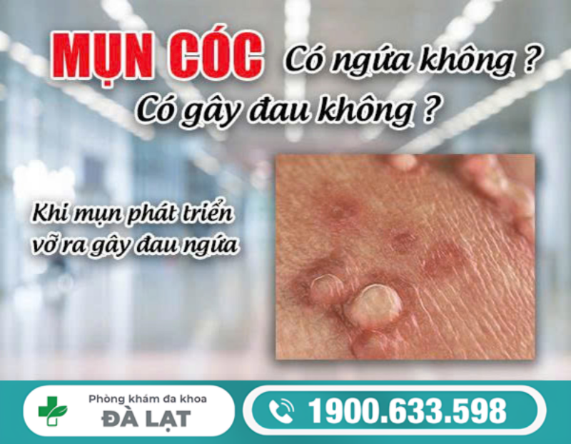 GIẢI ĐÁP: MỤN CÓC SINH DỤC CÓ NGỨA KHÔNG, CÓ GÂY ĐAU KHÔNG?