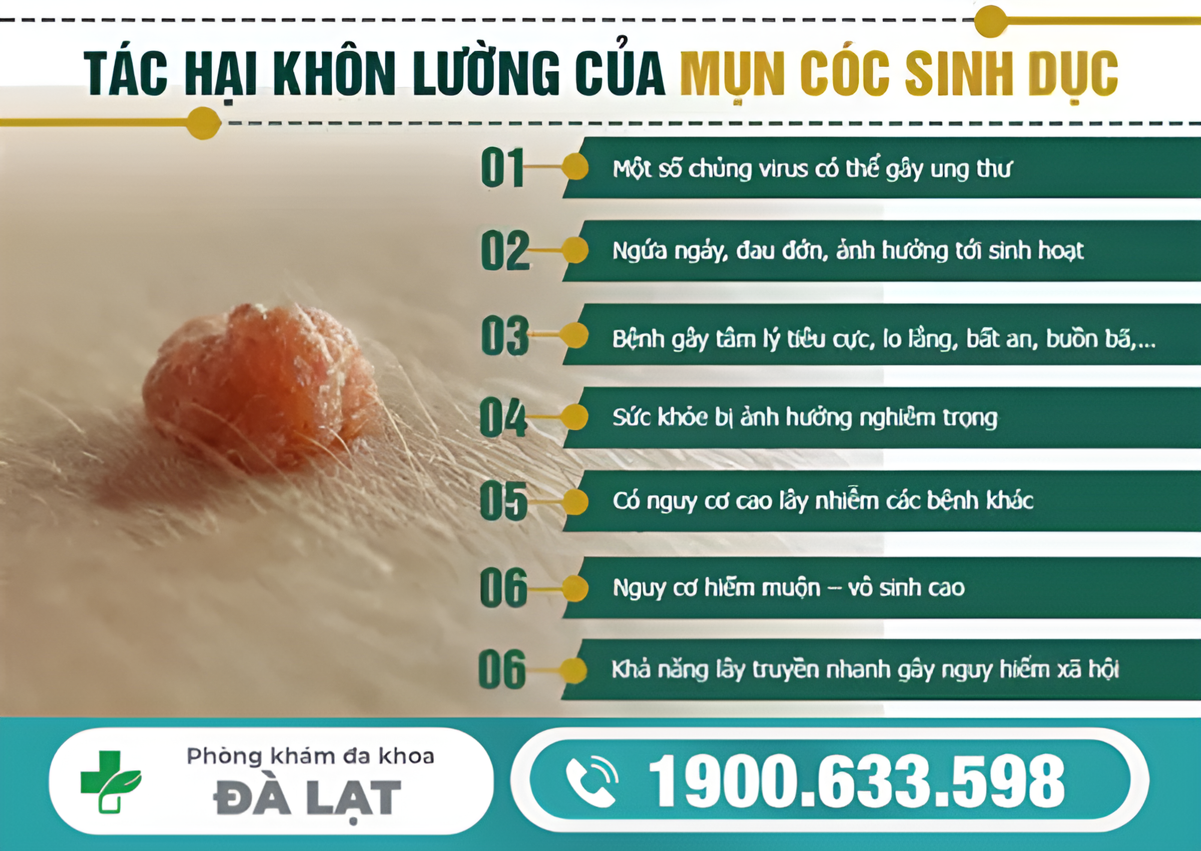 MỤN CÓC SINH DỤC CÓ ẢNH HƯỞNG NGUY HIỂM KHÔNG?