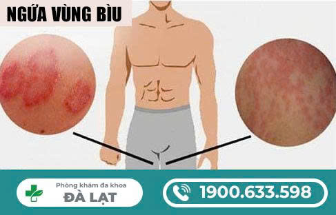 Mụn Ngứa Ở Bìu Tinh Hoàn Nam Giới 