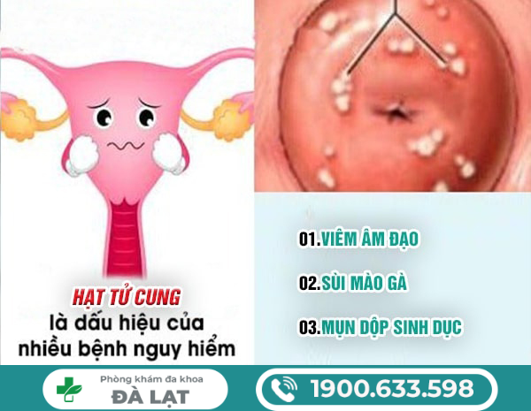 Nổi Hạt Ở Cổ Tử Cung Nữ Giới 