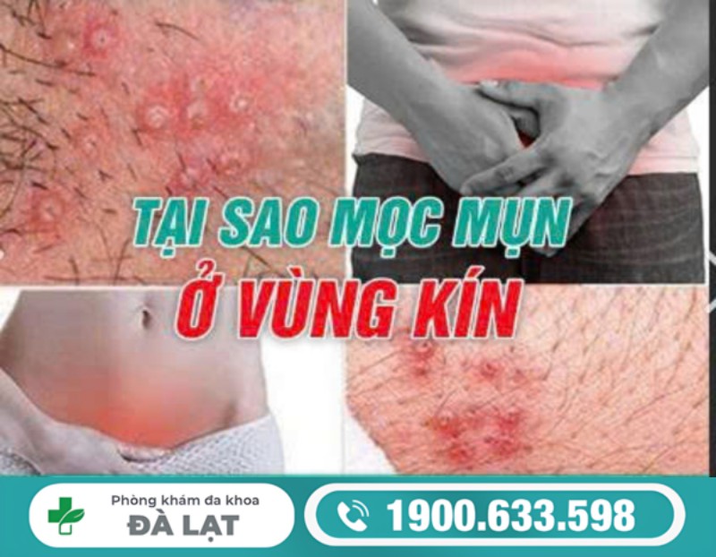 CÔ BÉ MỌC MỤN THỊT CẢNH BÁO BỆNH GÌ?