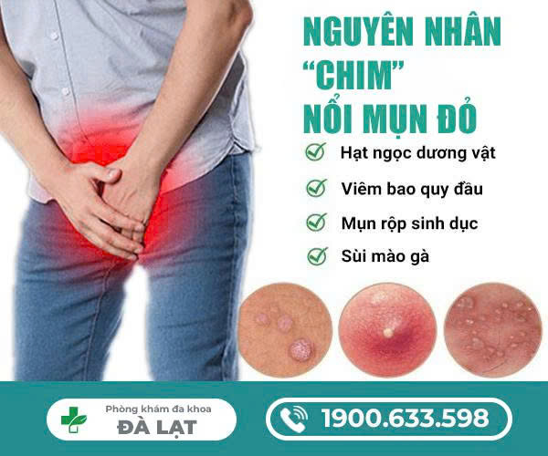 Chim Bị Nổi Mụn Đỏ Ở Nam Giới 