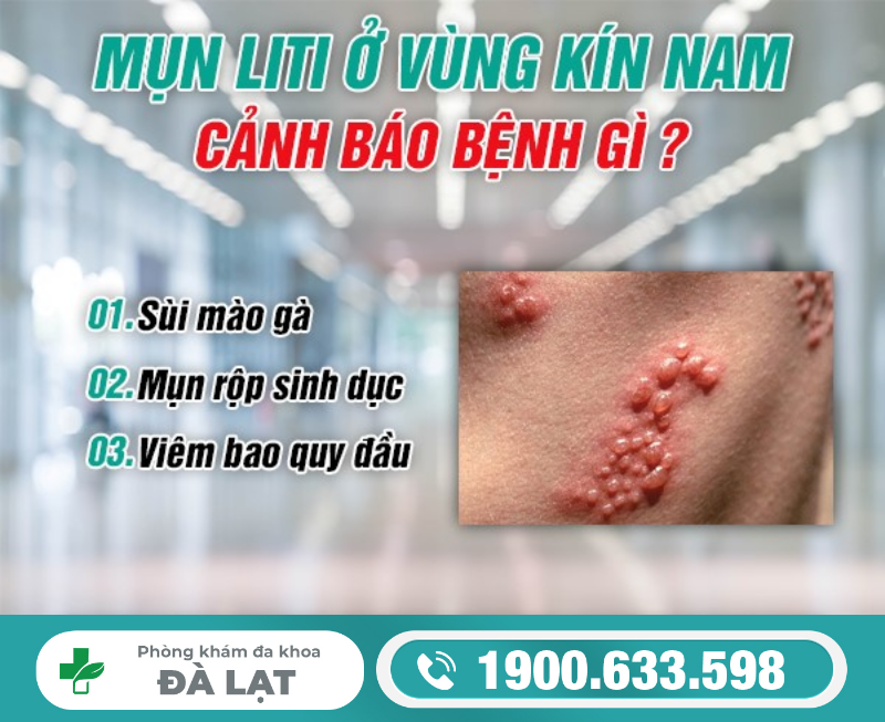 Hiện Tượng: Chim Bị Nổi Mụn LiTi Ở Nam Giới 