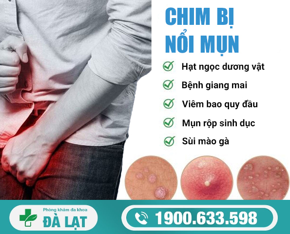 Chim Bị Nổi Mụn Trắng Ở Nam Giới 