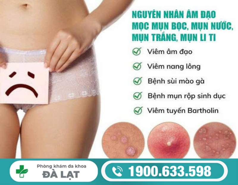 GIẢI ĐÁP: TẠI SAO CÔ BÉ BỊ NỔI MỤN?