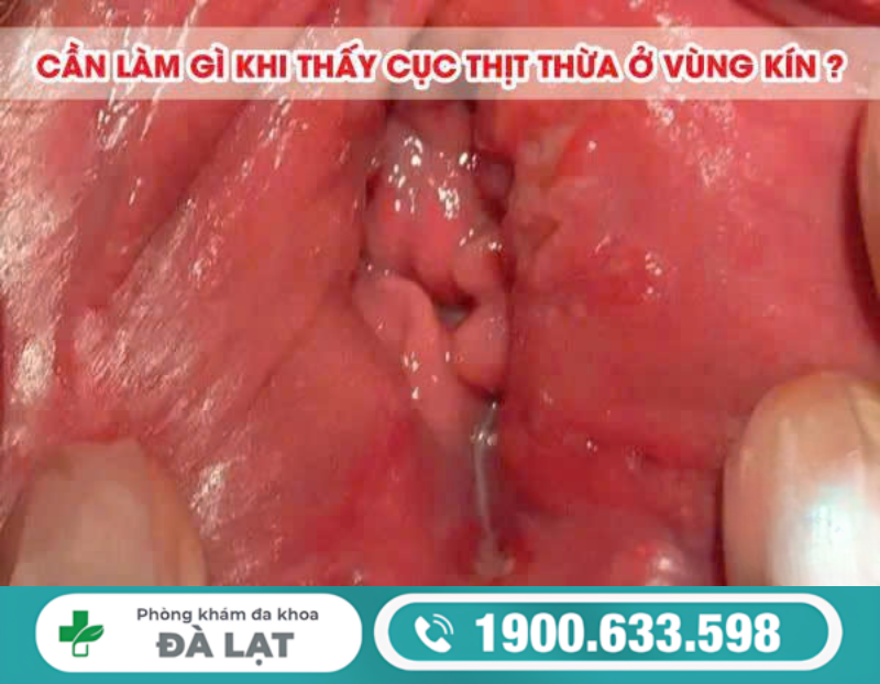 PHƯƠNG PHÁP CẮT THỊT THỪA VÙNG KÍN HIỆN NAY