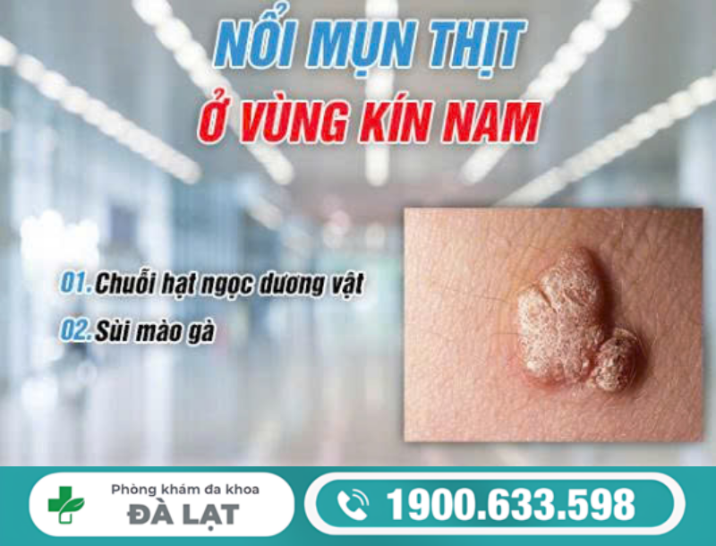 NỔI MỤN THỊT Ở VÙNG KÍN NAM DO ĐÂU?