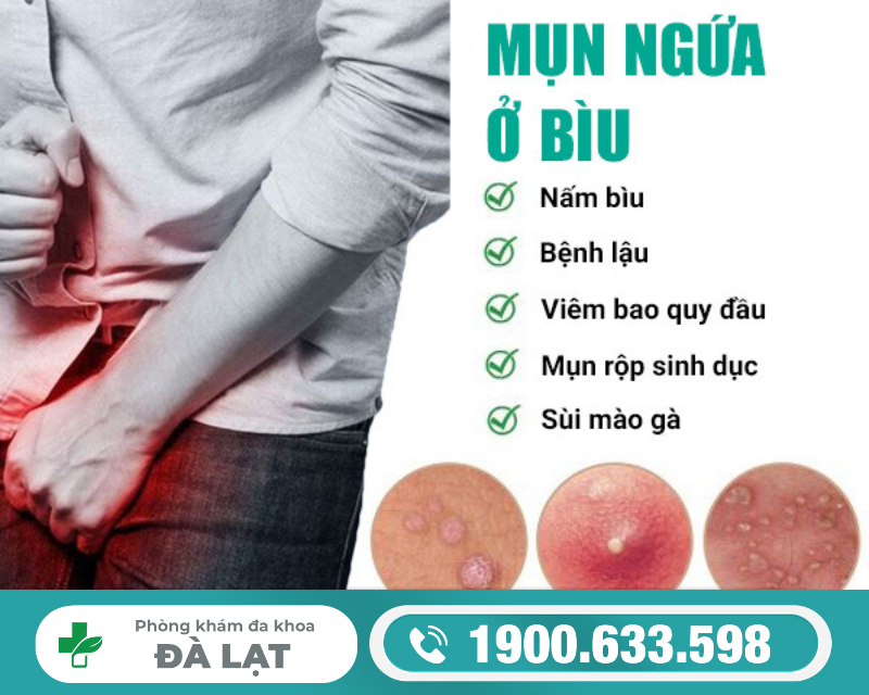 CÁCH CHỮA MỤN NGỨA VÙNG KÍN