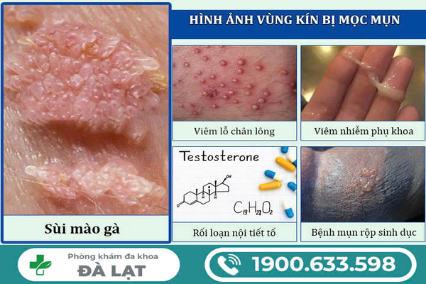 MỌC MỤN ẨN Ở VÙNG KÍN