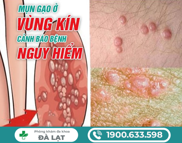 MỌC MỤN GẠO Ở VÙNG KÍN