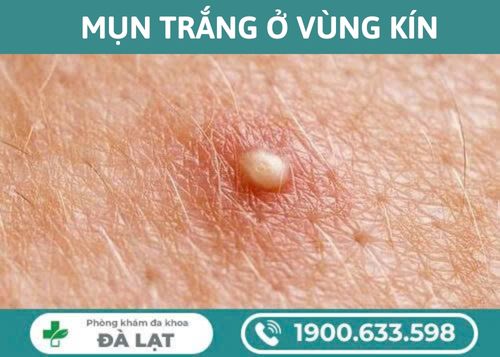 MÔI BÉ NỔI MỤN TRẮNG CẢNH BÁO BỆNH PHỤ KHOA NÀO?